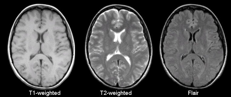 T1 weighted mri blood