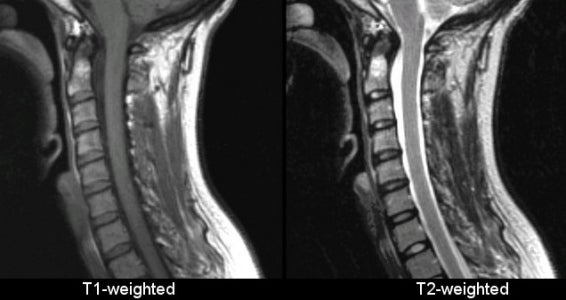 MRI