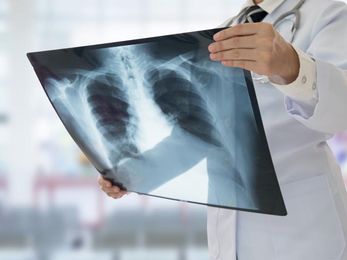 Close up of Doctor examining chest x-ray film of patient at hospital