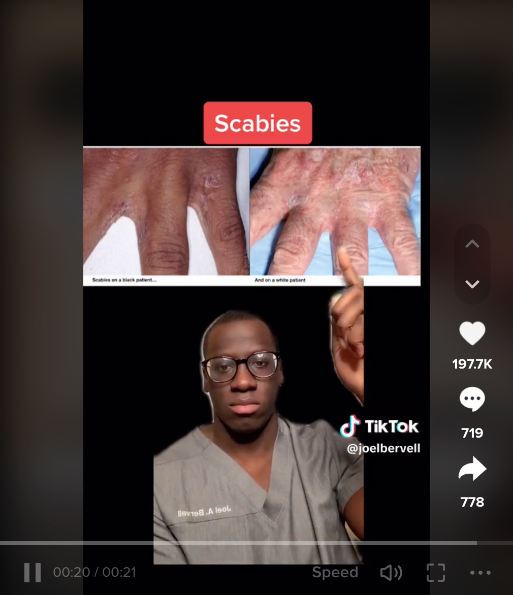 Social media medical educator, medical mythbuster, medical student, and CTSC Black History Maker Joel Bervell, created a TikTok about how skin diseases present on black versus white skin.