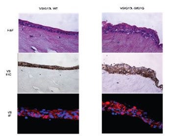 three dimensional OTC of EPC-2 cells shows normal morphology in cells transfected with wild type VSIG10L (left) versus mutant VSIG10L (right).