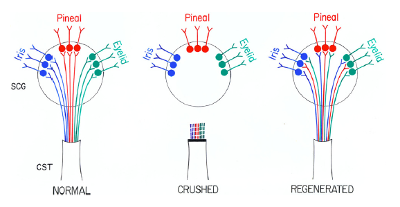 Model of misrouting of fibers during reinnervation of the SCG. fist labelled normal with fibers labelled Iris, in blue, Pineal, in red, and Eyelid, in green radiating form bottom cone named CST into circle named SCG. second labelled crushed with same sturcture except fibers are severed. last labelled Regenerated with model similar to first except Iris, Pineal & Eyelid each have blue, red, green fibers.