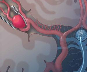 Aneurysm image