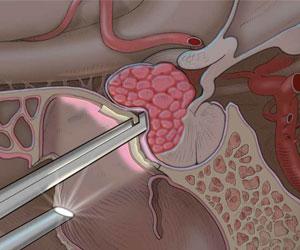 Image of tumor