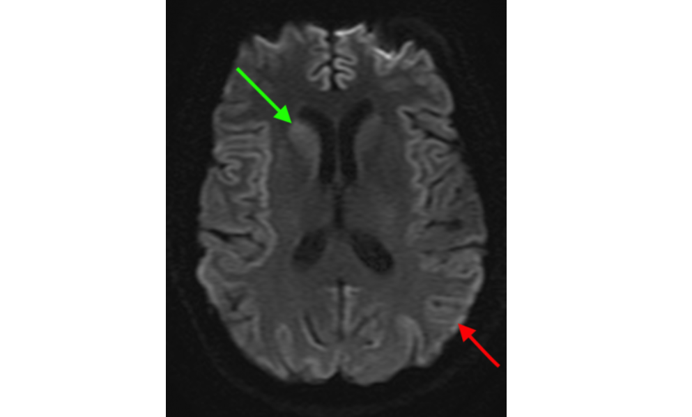 Brain MRI suggestive of CJD