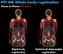 PET/MR whole body registration 