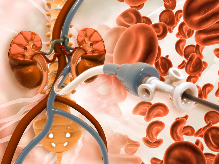 A 3d illustration of a Stent angioplasty to treat Peripheral artery disease.