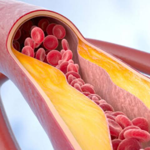 stock graphic depiction of atherosclerosis in a vascular structure