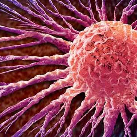 graphic image of breast cancer