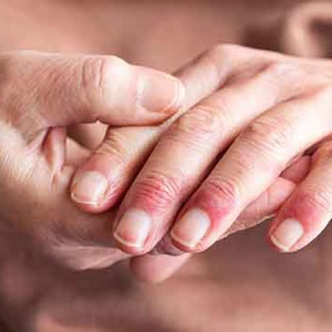 stock image of hands with psoriasis rash