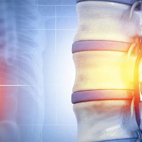 Graphic image showing area of spinal cord injury
