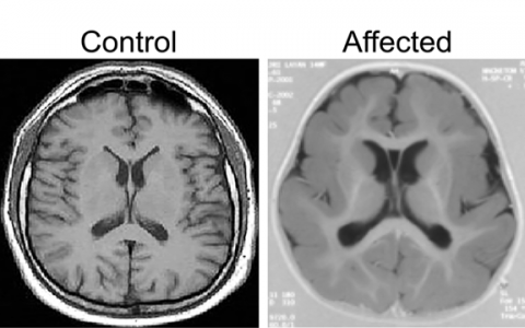image of scans of unaffected brain and an affected brain with pachygyria.