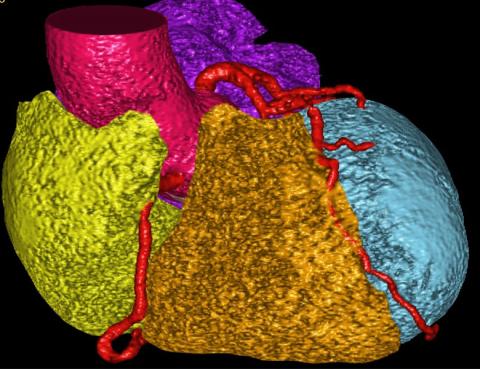 CT image of heart with color coding