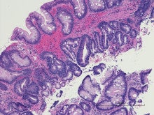 Barrett's Esophagus