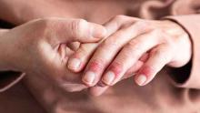 stock image of hands with psoriasis rash