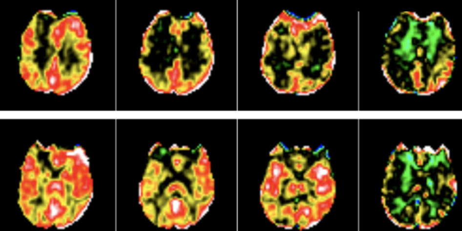 Cerebral blood flow changes under hypoxia