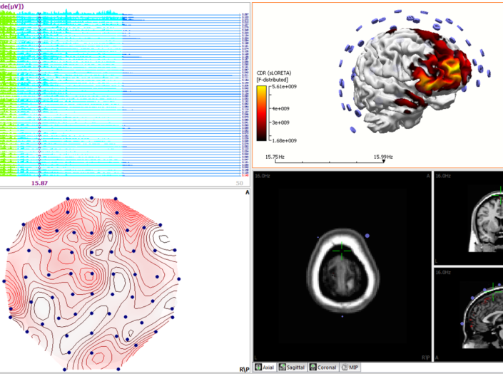 EEG and MRI analysis of brain