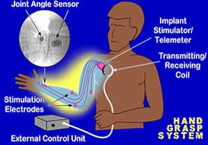 Illustration of a Functional Electrical Stimulation of the arm for paralyzed patients (FES center of Cleveland)