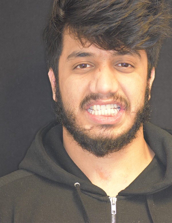 Photo of Talha Ali showing teeth implant
