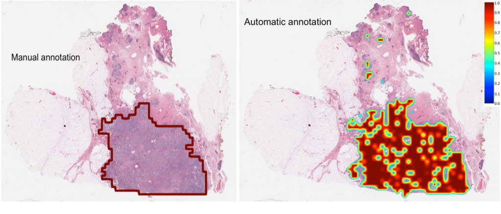 A side-by-side comparison of a breast cancer tumor delineated by a pathologist and the same tumor delinated by a computer. Both drew the boundaries on a digitized image made from a biopsy slide.