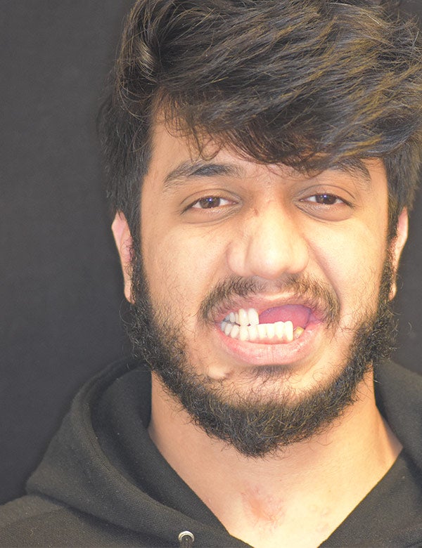 Photo of Talha Ali before he had teeth implanted