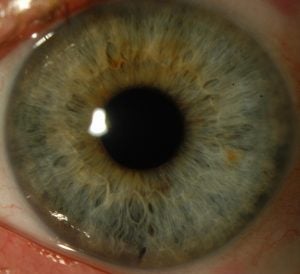 DMEK Slit Lamp DEKS Copy 300x274