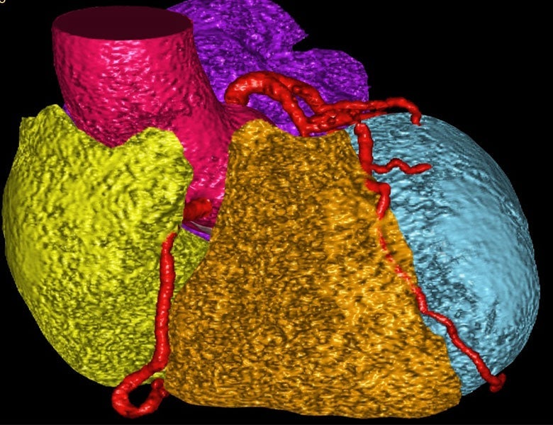A color-coded CT scan of a patient's heart.