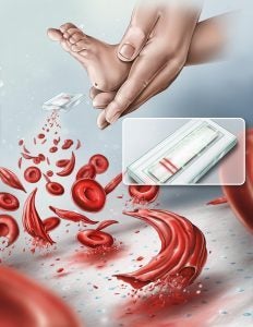 Illustration of a heel prick using the HemeChip. Illustration by Grace Gongaware, student at the Cleveland Institute of Art.
