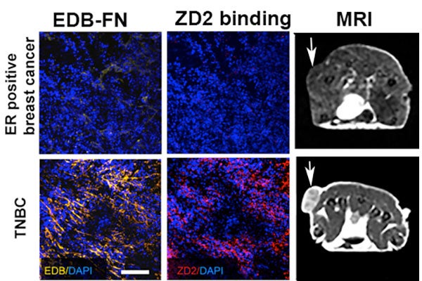 The figure shows the different expressions of the biomarker (EDB-FN) and probe binding (ZD2) in slow-growing ER-positive breast cancer (not much yellow and red color representing low expression of the biomarker and low binding), and in triple- negative breast cancer (TNBC, high expression and high binding). As a result, the targeted contrast agent produced weak signal enhancement (brightness) in the former and strong signal (brightness) in the latter as referenced by the arrow.