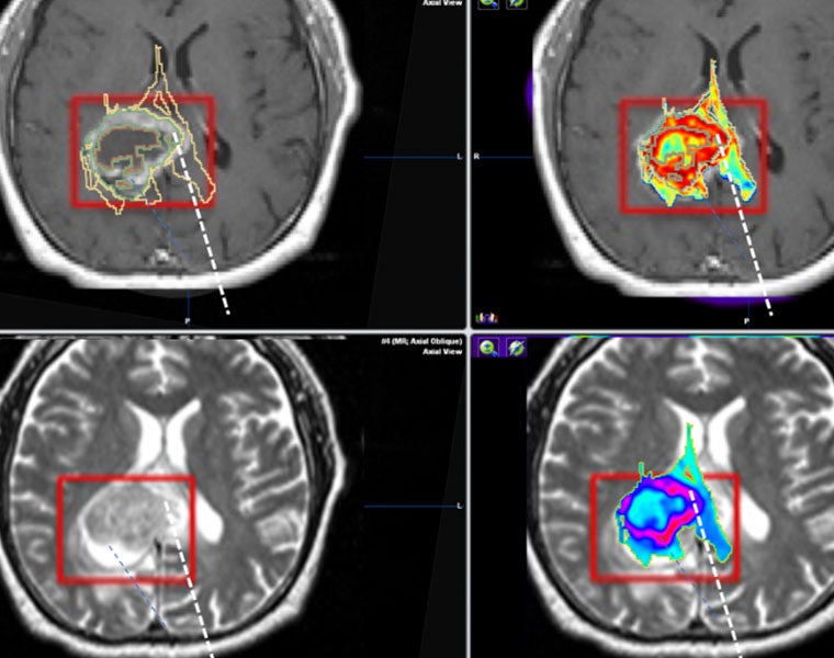 Actual brain scan images showing color-coded areas where neurosurgeons would look to find a tumor