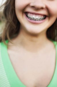 braces Braces 199x300