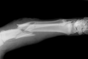 broken-bone.jpg