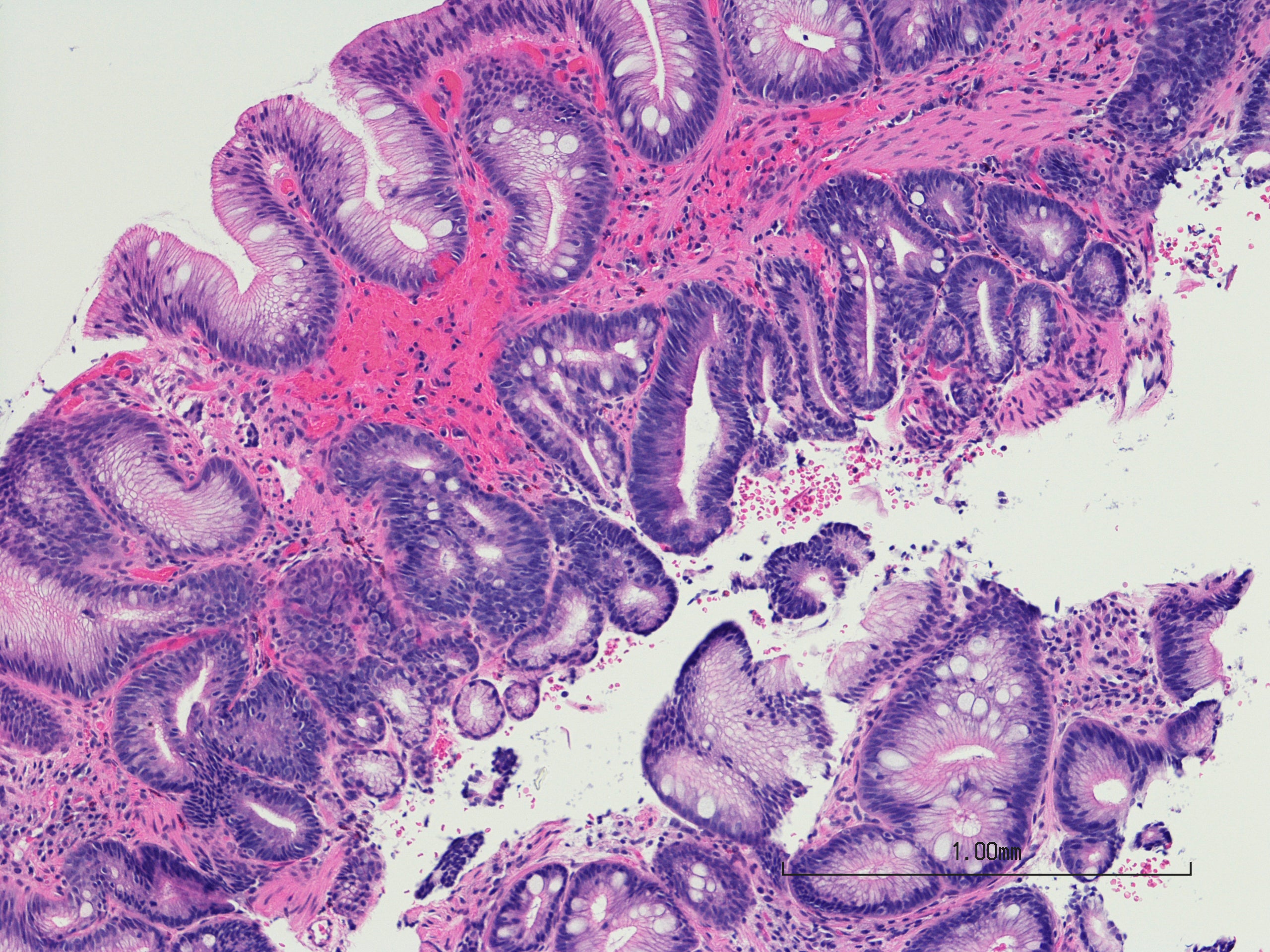 Barrett's Esophagus