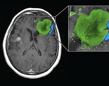 Image of brain tumor.