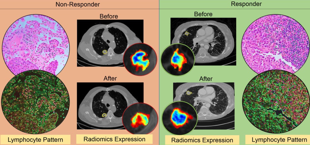A diagram showing thed differences in CT radiomic patterns before and after initiation of checkpoint inhibitor therapy.