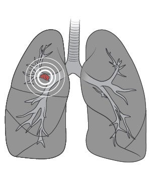 Illustration of lung CT screening technology