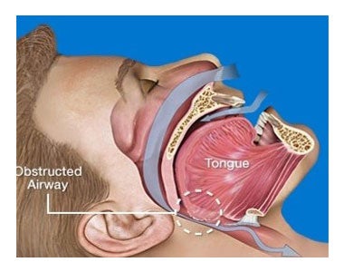 Image of airway obstruction.