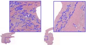 Graphic showing benign tissue next to prostate tumor