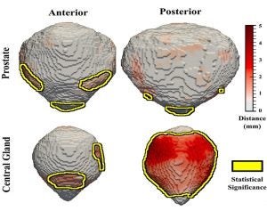 Front and rear images of a cancerous prostate and a noncancerous central gland.