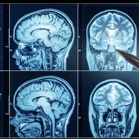 Photo of a doctor&#039;s hand pointing to a spot on MRI scans of the brain