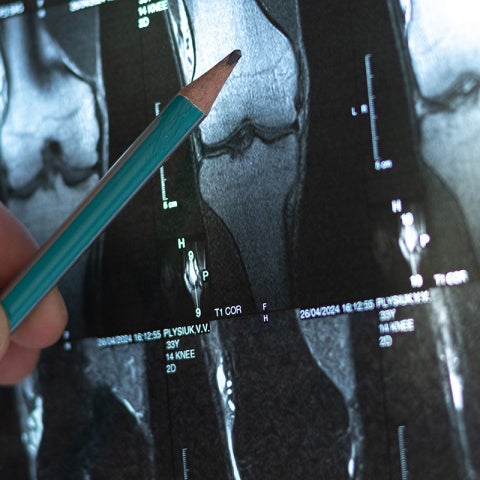 Close up photo of a doctor pointing to a spot on an x-ray of bones