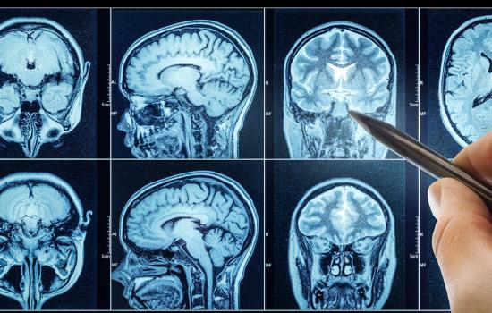 Photo of a doctor's hand pointing to a spot on MRI scans of the brain