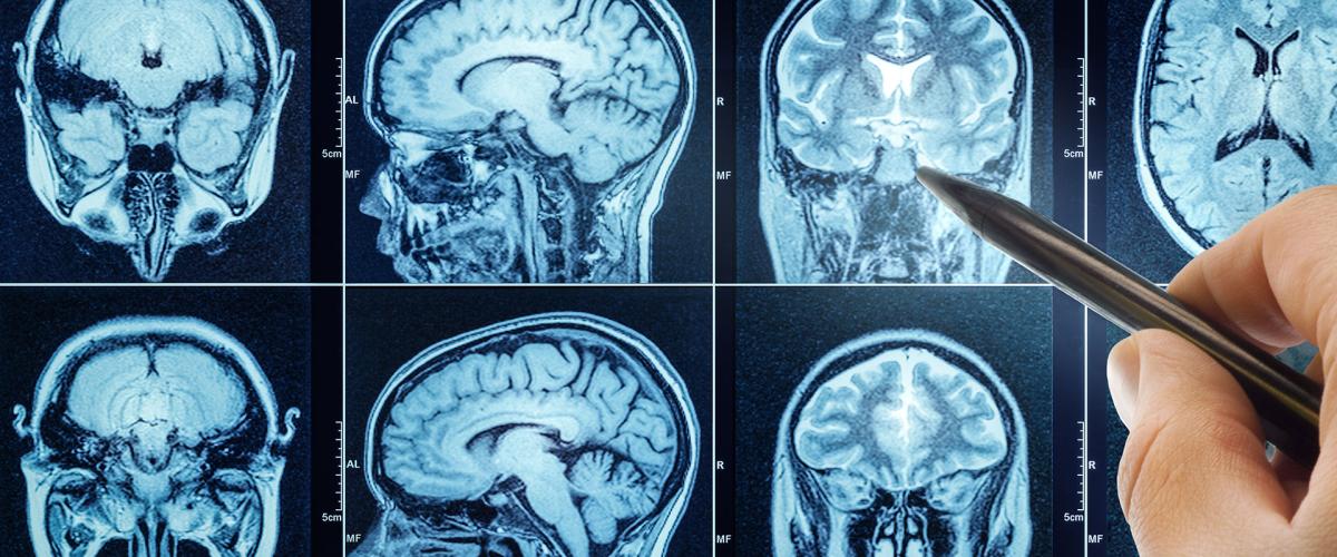 Photo of a doctor's hand pointing to a spot on MRI scans of the brain