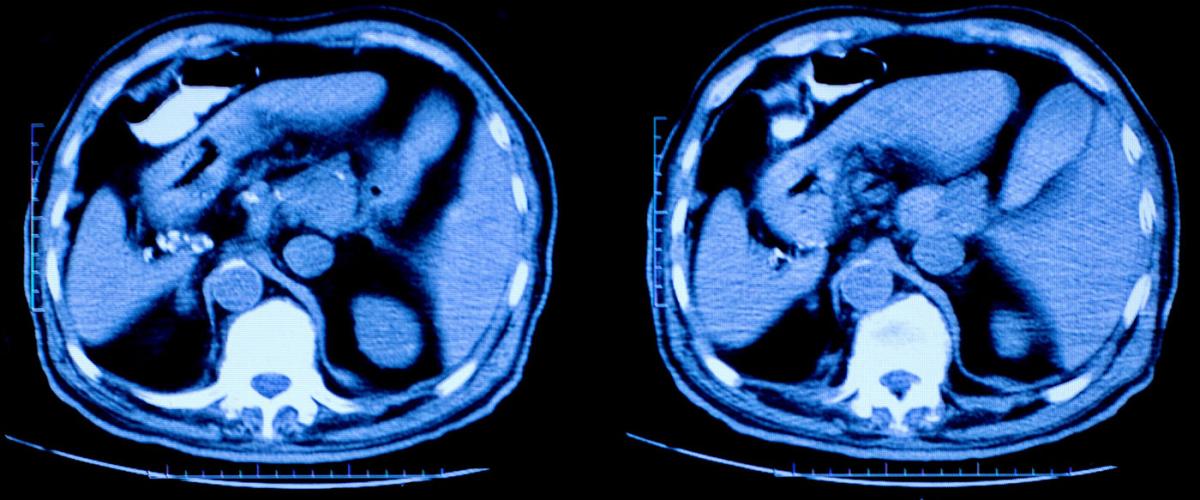 MRI