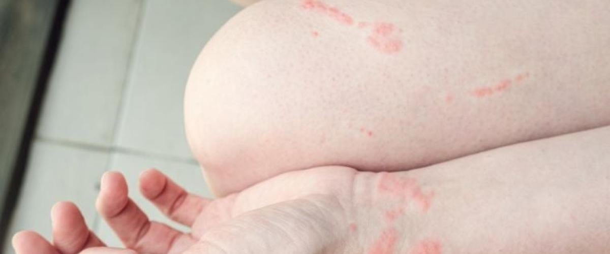 allergic-reaction