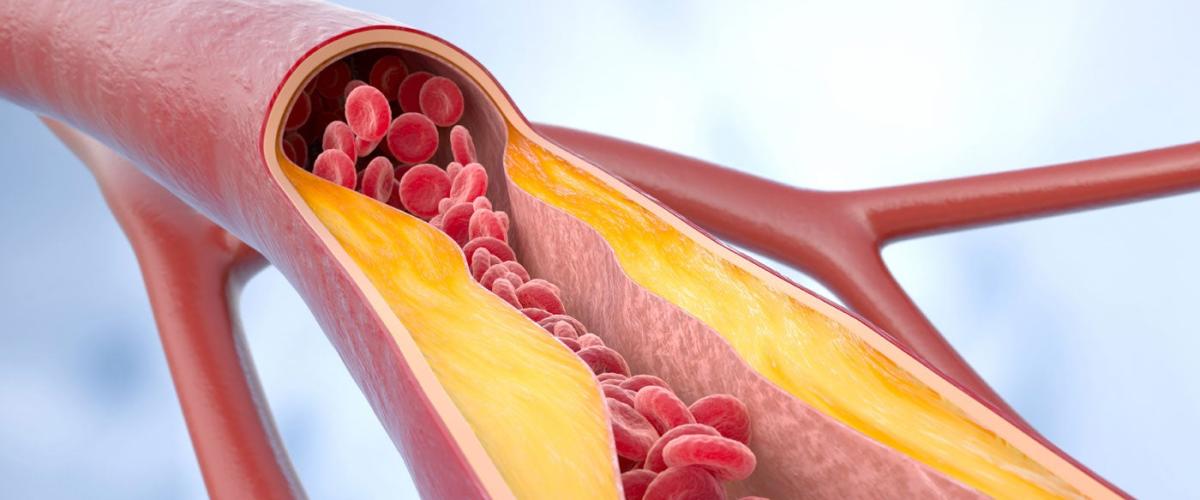 atherosclerosis-feat