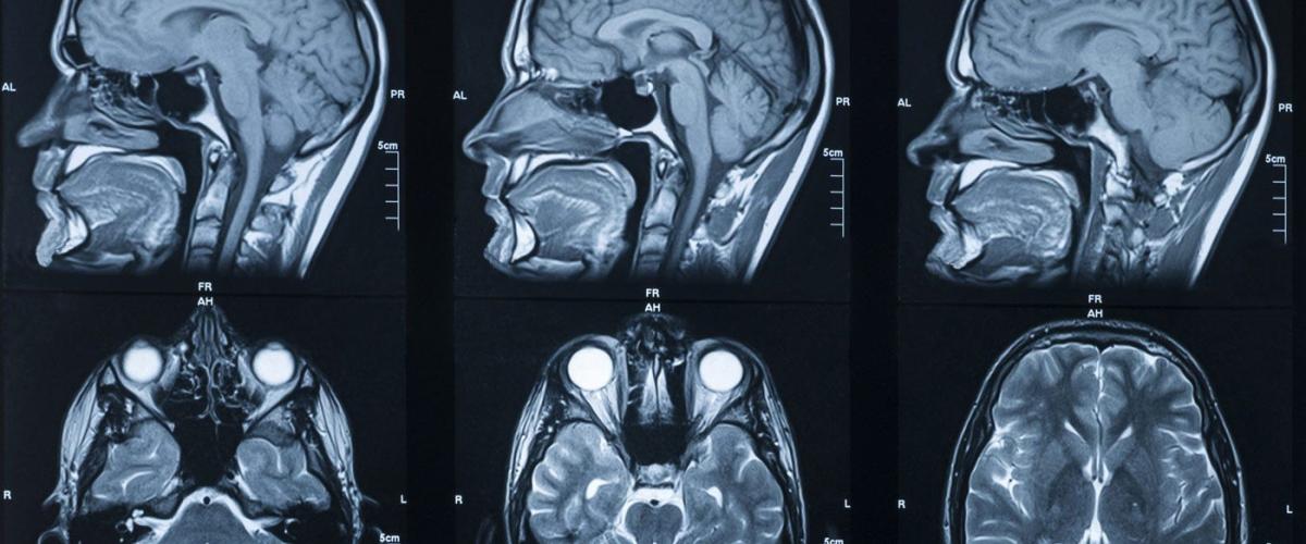 brain-scan-feat