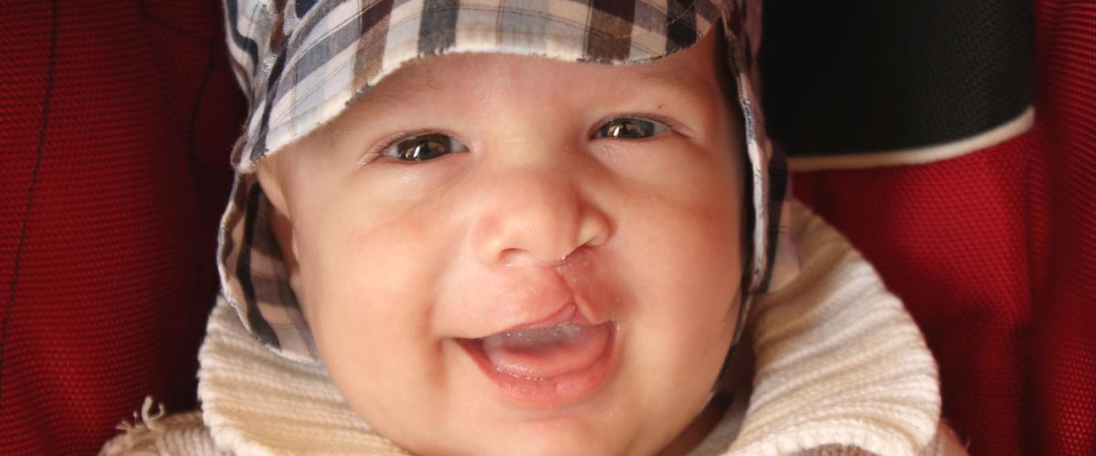 cleft-palate