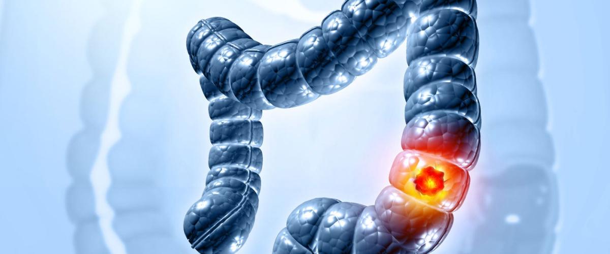 colorectal-cancer-feat