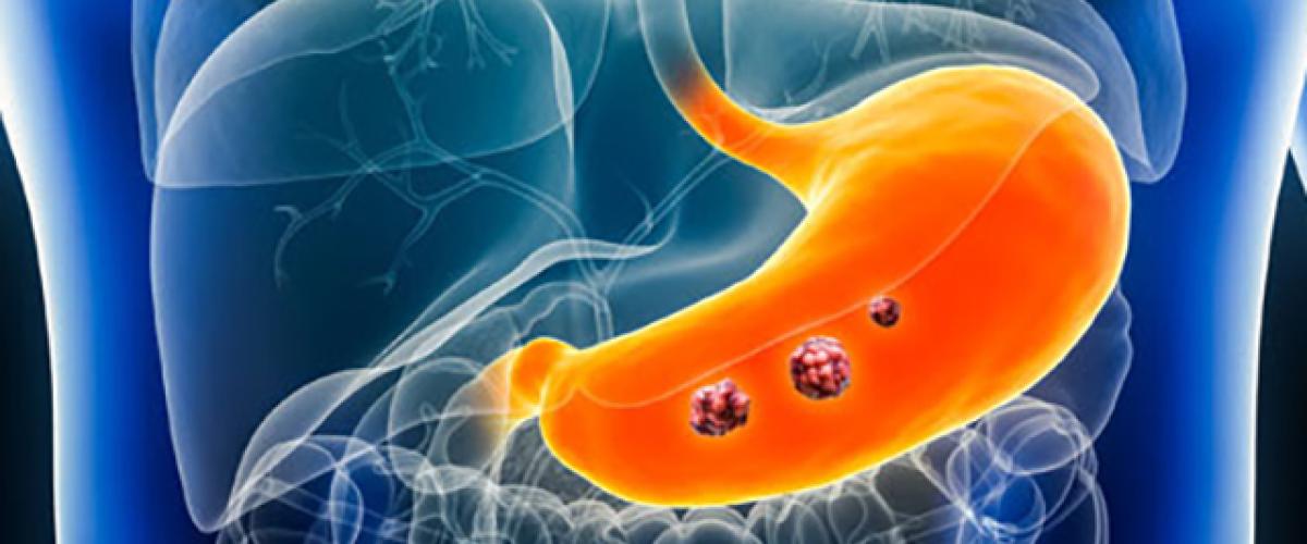 169gastriccancer.jpg